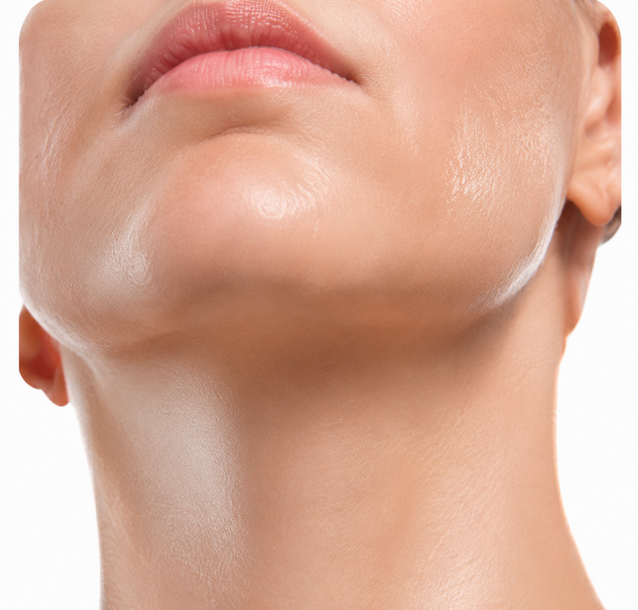 Microneedle RF