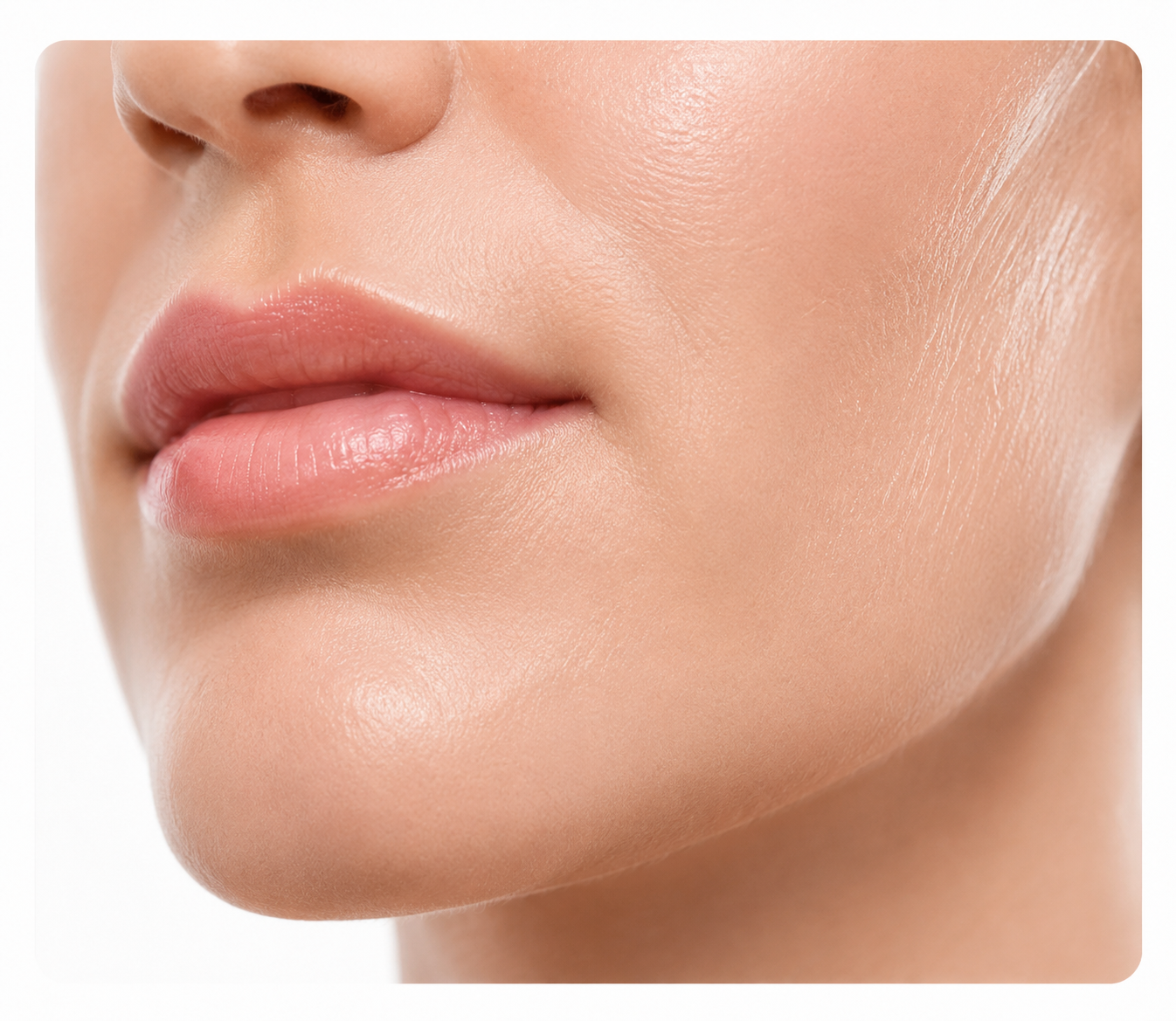 Microneedle RF