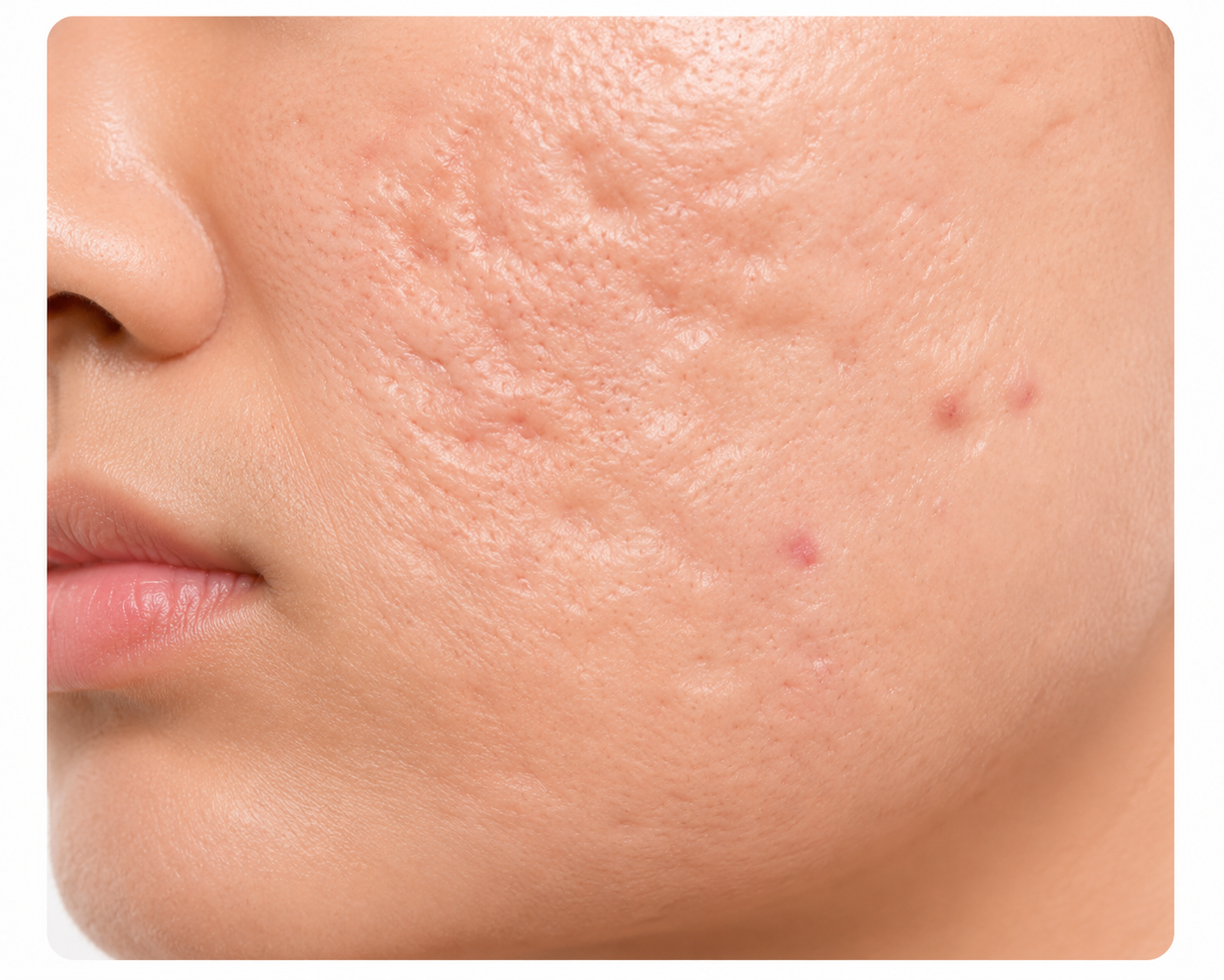Microneedle RF