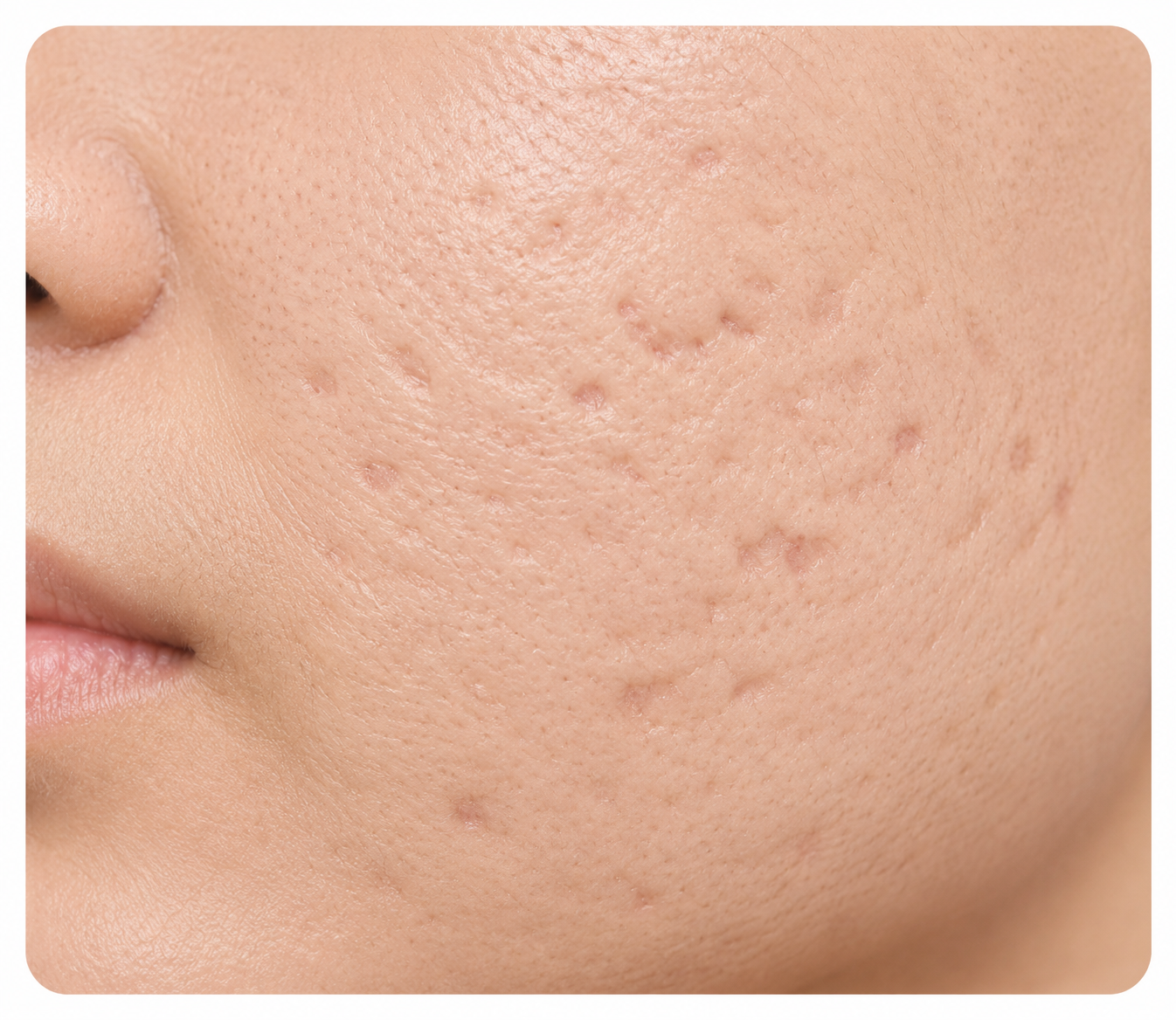 Acne Scar Removal