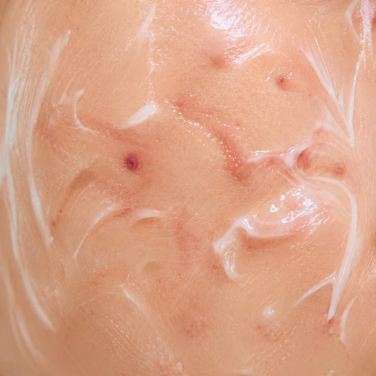 Acne Scar Removal
